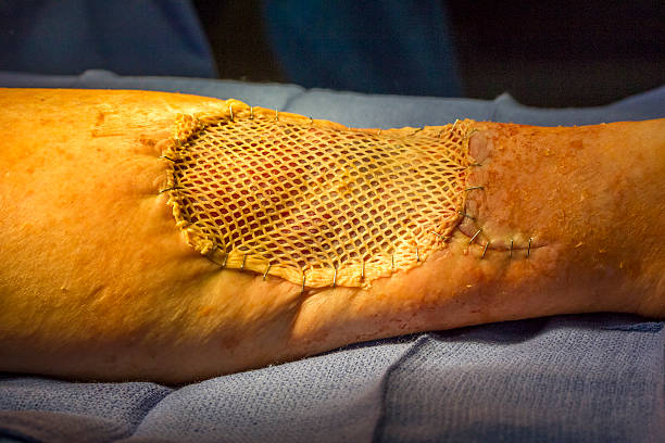 त्वचेचे प्रत्यारोपण (Burn Skin Grafting)